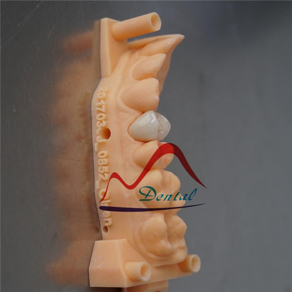 Dental Digital printed model for E-max crown 5