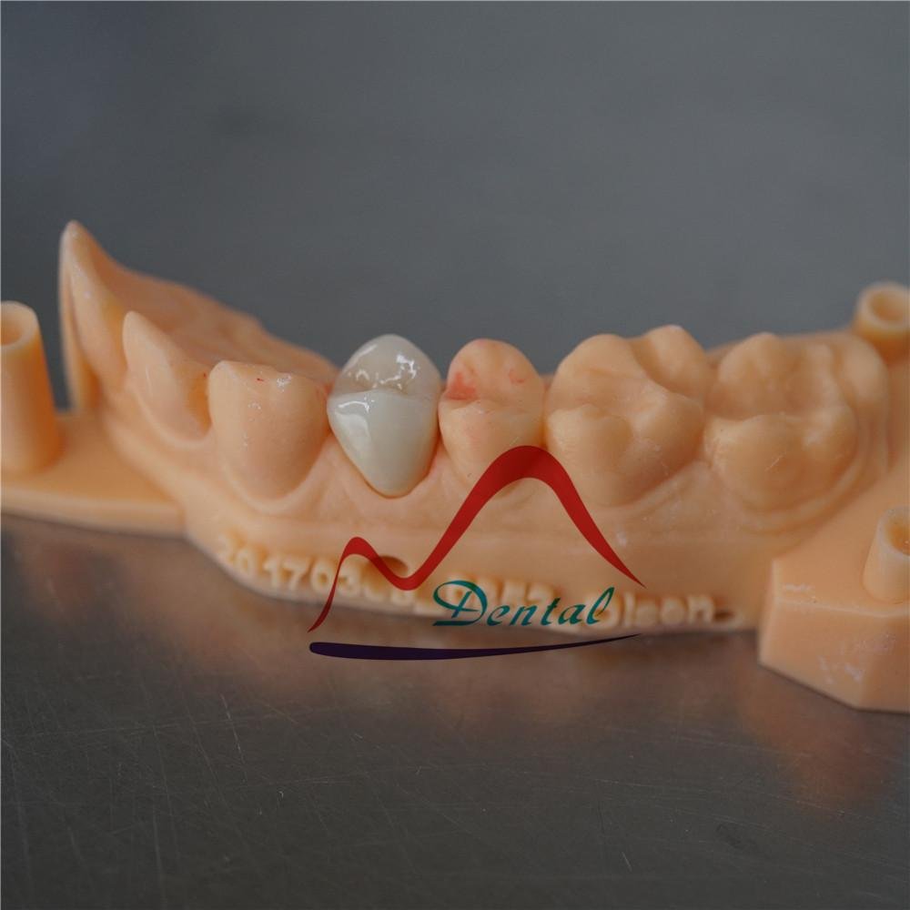 Dental Digital printed model for E-max crown 4