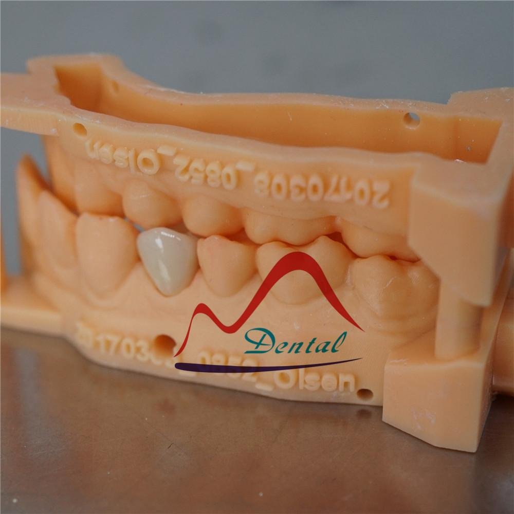 Dental Digital printed model for E-max crown 3