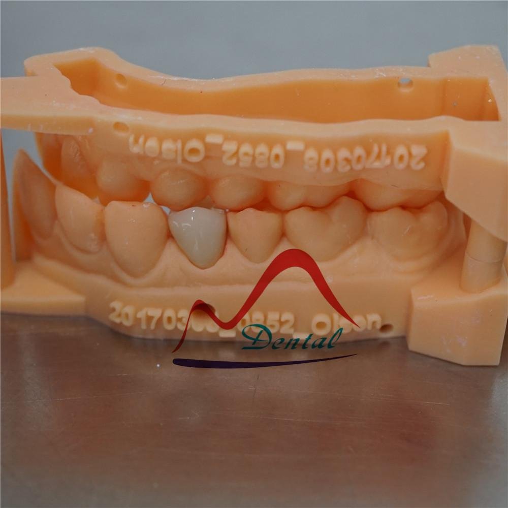 Dental Digital printed model for E-max crown 2