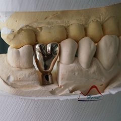 Dental implant full metal gold crown