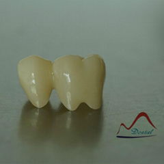 Full Contour Zirconia Crown and Bridge