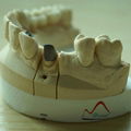 Dental NP Post and Core Crown 4