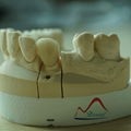 Dental NP Post and Core Crown 3