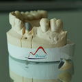 Dental NP Post and Core Crown 2