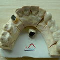 Dental NP Post and Core Crown 1