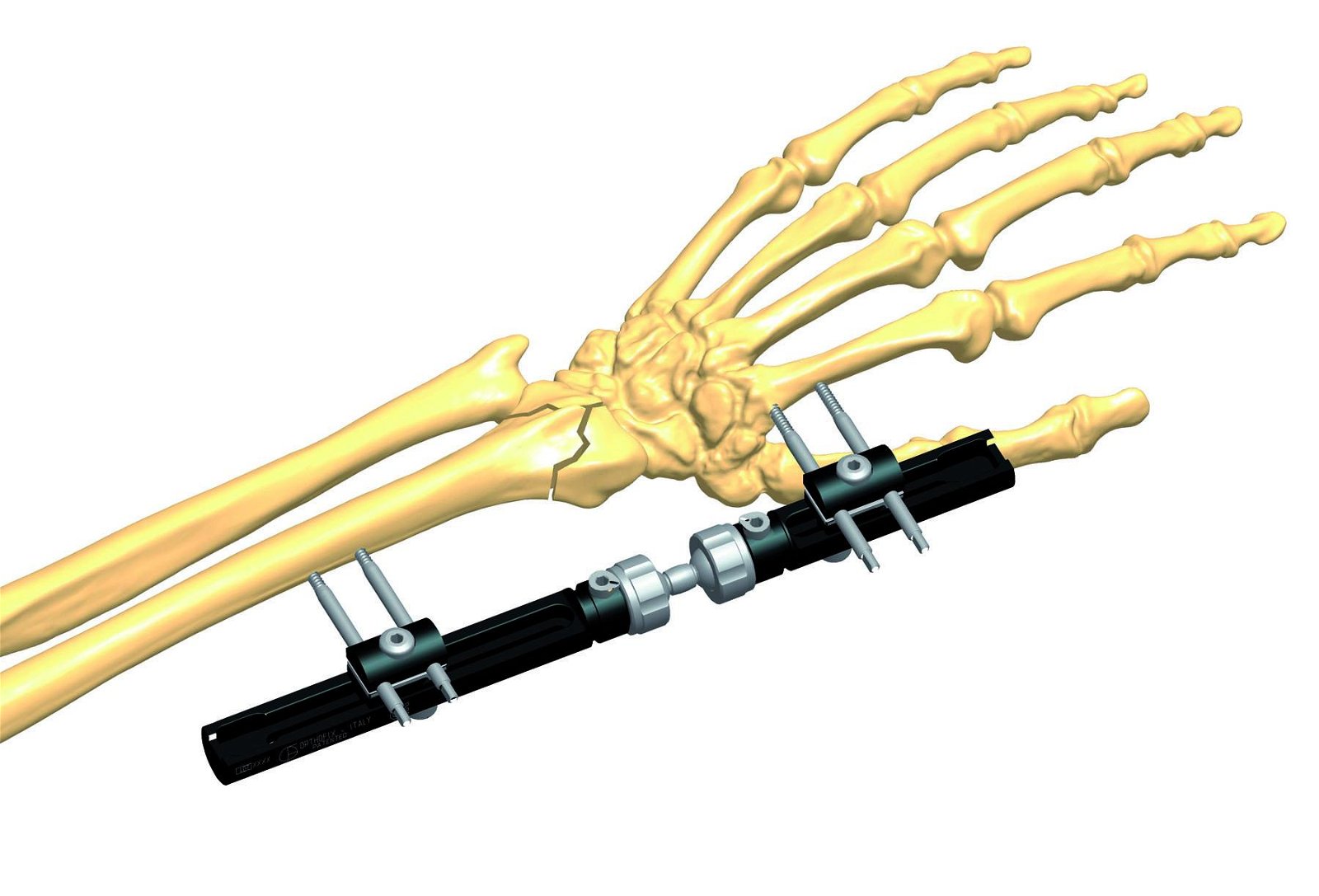 Wrist Joint Fixator 3