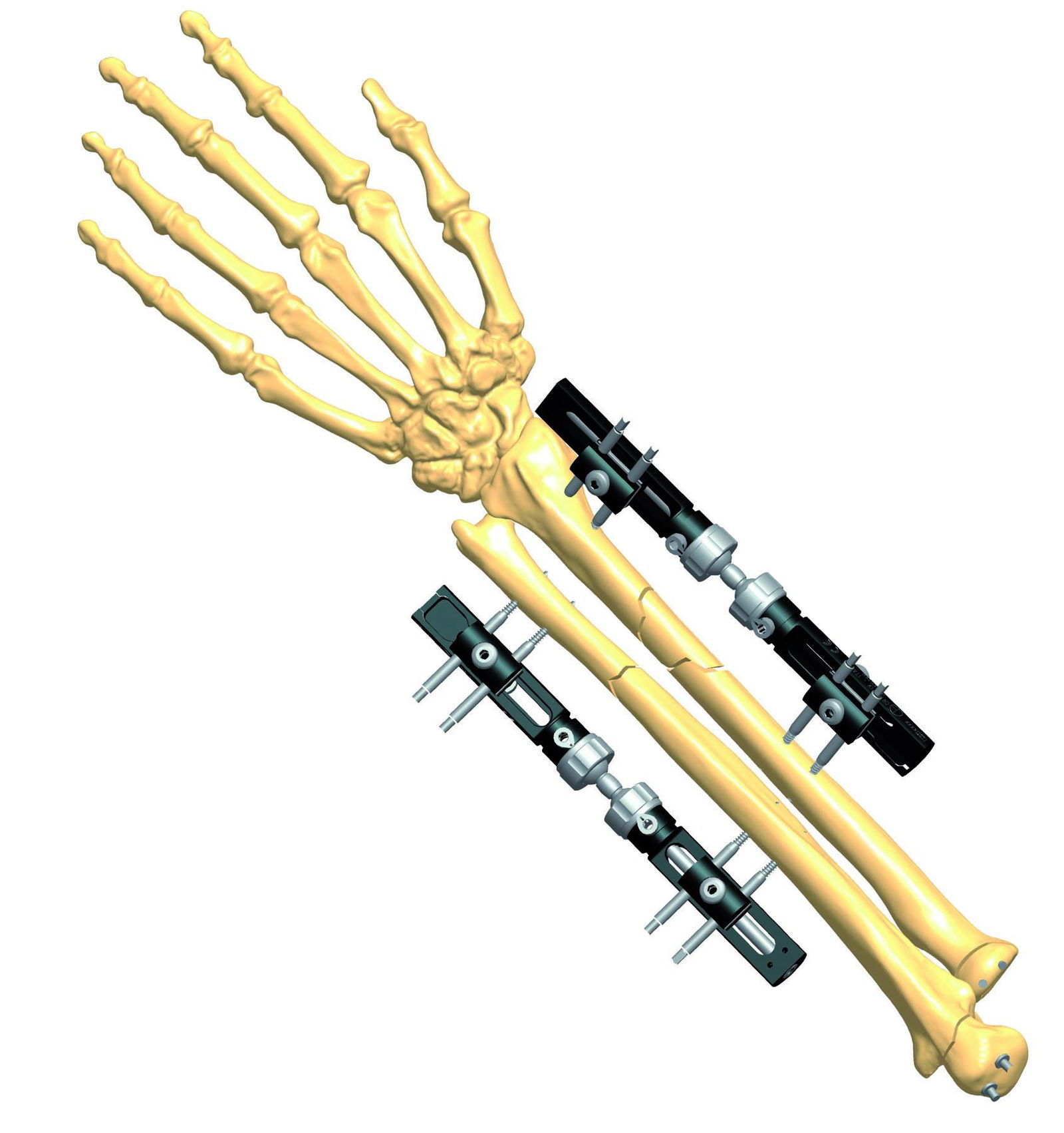 Wrist Joint Fixator 4