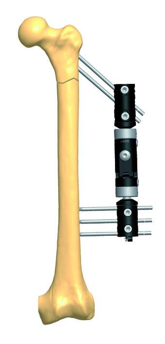 Intertrochanteric Femoral Fixator 2