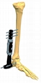 Ankle Joint Fixator