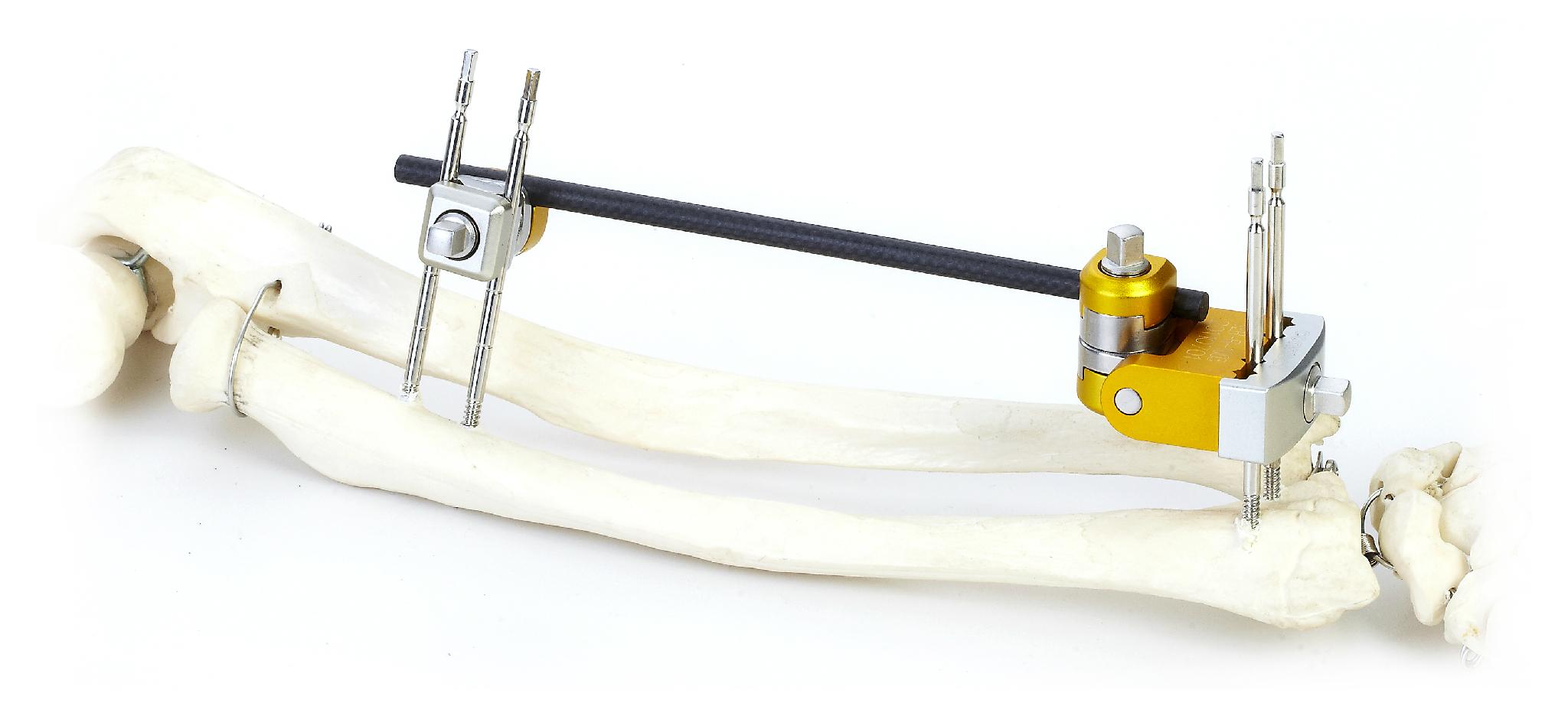 sk组合式外固定支架(上肢系列) - 正合zener (中国 生产商) - 医疗