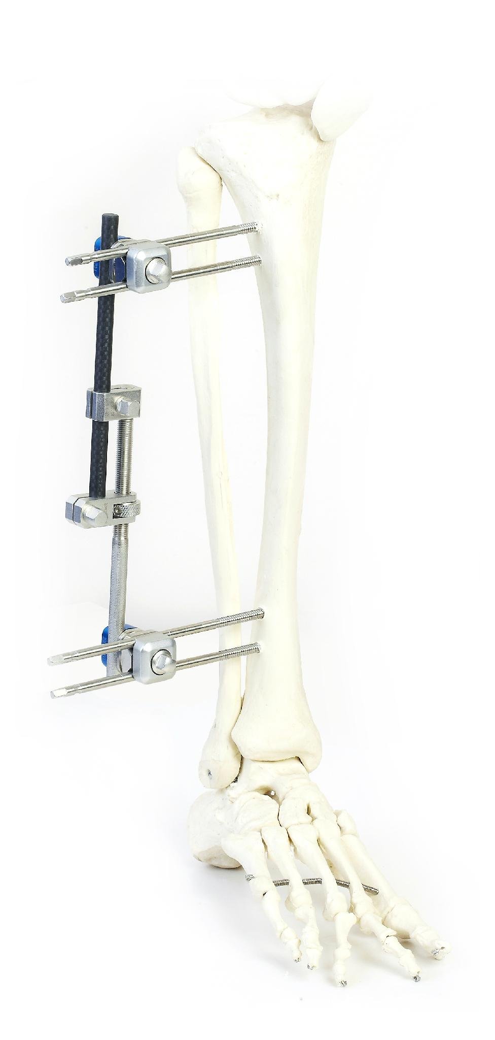 SK Combined External Fixator(Large Bone) 6