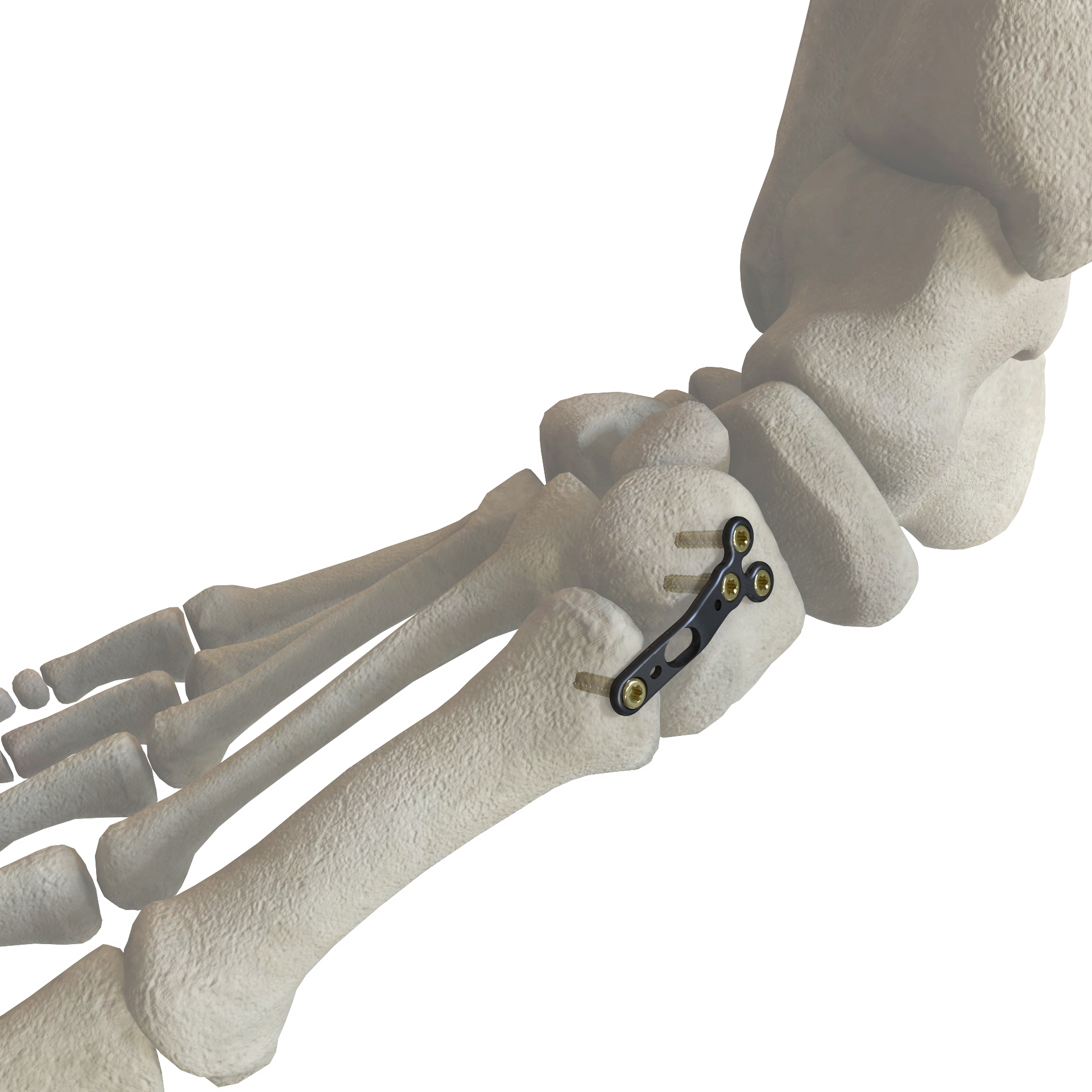 第一跖楔关节内侧板 - 正合zener (中国 生产商) - 医疗服务 - 服务业