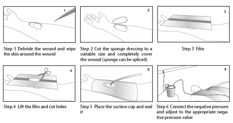 Single use negative pressure wound therapy kit- Bodyguard II,Wound Care,Drainage 2