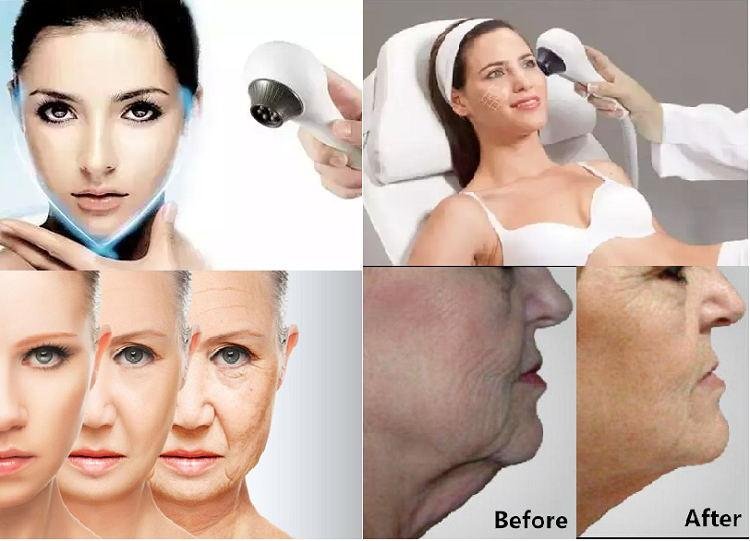Facial Wrinkle Removal Thermolift Machine 5
