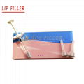 sodium hyaluronic acid Lip Filler 1