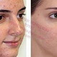 FDA certificate skin rejuvenation Fractional CO2 Laser 3