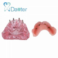 High quality teeth study dental implant restoration model interior maxillary
