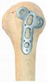 Humeral large nodule locking plate-Placa