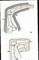 Tratamiento de fracturas metacarpianas