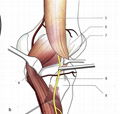 Placa de bloqueo para tibia proximal medial