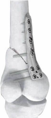 Placa LCP de osteotomía para fémur distal medial