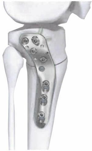 Proximal lateral tibial osteotomy plate-Placa de osteotomía para tibia proximal 2