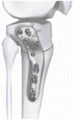 Placa LCP de osteotomía para tibia proximal lateral