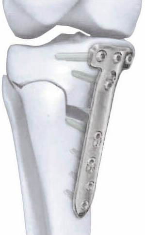 Proximal medial tibial osteotomy plate I