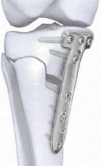 Proximal medial tibial osteotomy plate I-Placa osteotomía para tibia medial