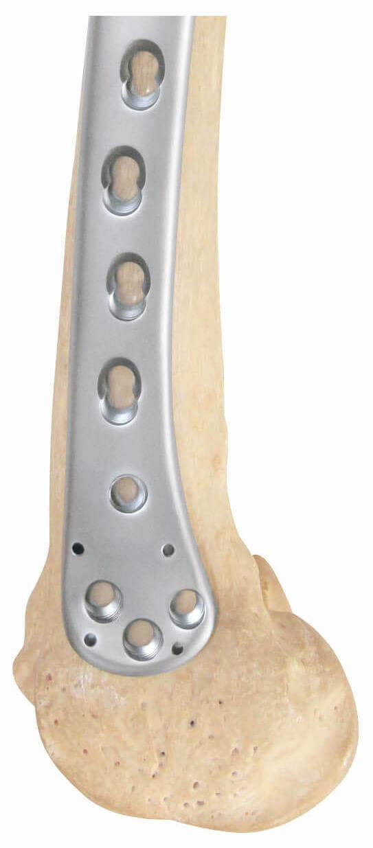 Femoral condyle locking plate - Placa de bloqueo para cóndilo femoral