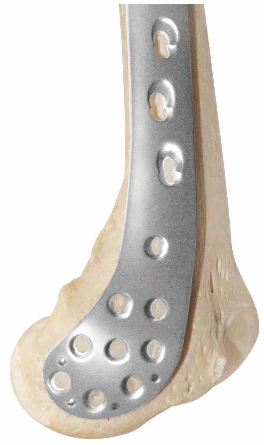 Distal medial femoral locking plate - Placa de bloqueo para fémur distal medial