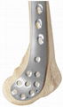 Distal medial femoral locking plate -