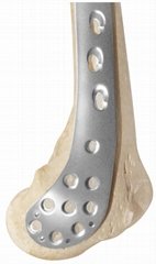 Distal medial femoral locking plate - Placa de bloqueo para fémur distal medial