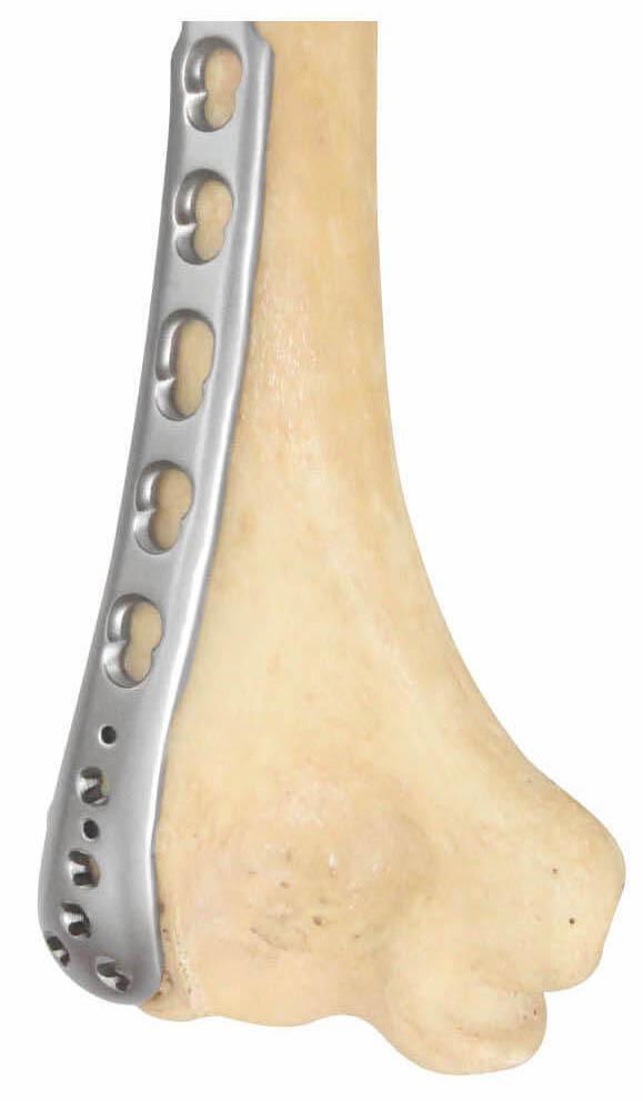 Distal Lateral humeral UNIVERSAL plate-placa ángulo variable para húmero lateral