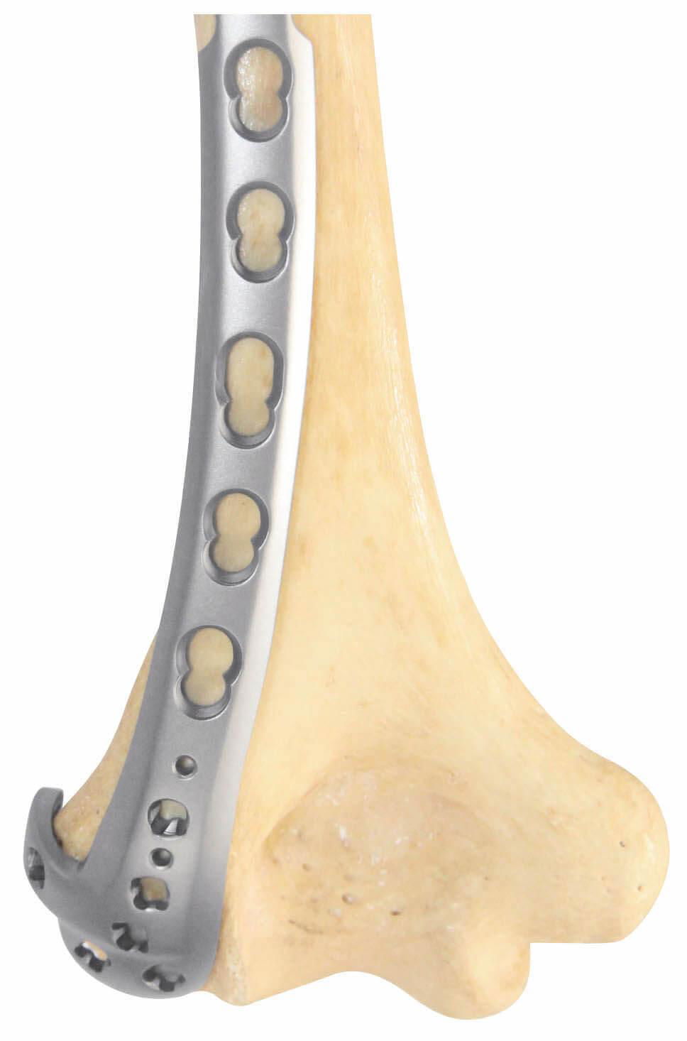Distal Lateral humeral UNIVERSAL plate-placa ángulo variable para húmero lateral 3