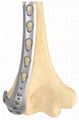 Distal Lateral humeral universal locking plate(L/R)