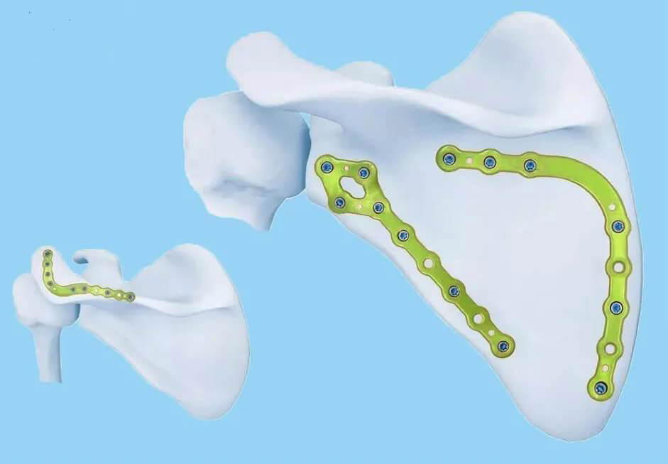 Scapular reconstruction locking plate III-Placa LCP de reconstrucción escápula