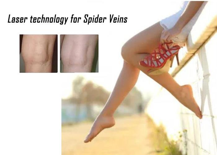 Different laser selection - compact size for spider vein treatment cover wide wa 2