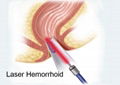 Dimed laser- BERYLAS offer noninvasive laser procedure for homerrhoid patients  4