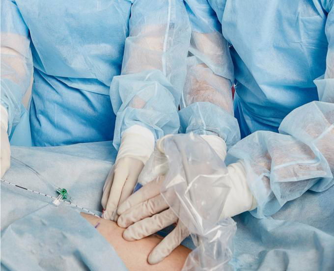 Durable Laser Ablation Of Saphenous Vein / Endovenous Ablation Leg