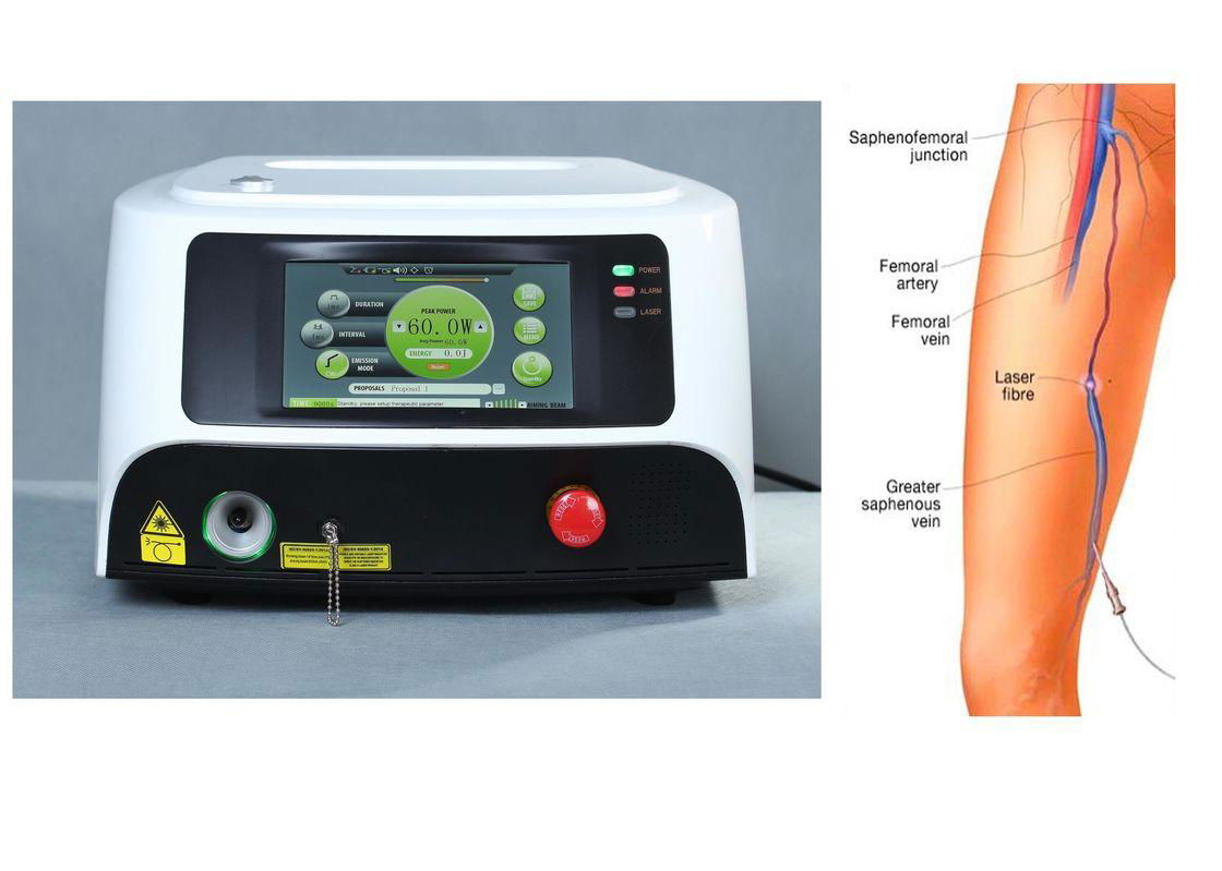 Durable Laser Ablation Of Saphenous Vein / Endovenous Ablation Leg Veins 3