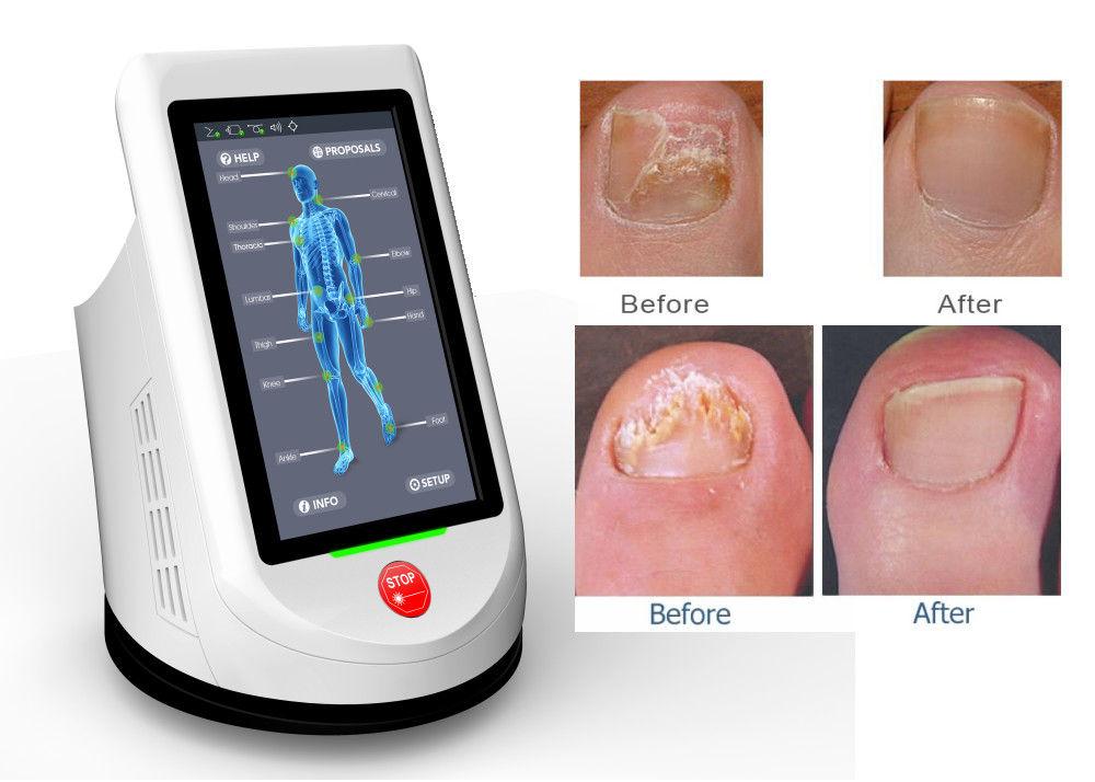 Best Nail Fungus Laser Machine to Kill Toenail Fungus 810/940/980nm