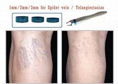 Effective Treatment of Leg Vein Telangiectasia with a New 940 nm Diode Laser