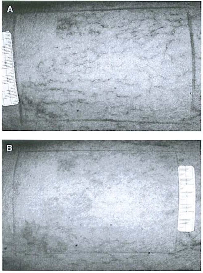 Effective Treatment of Leg Vein Telangiectasia with a New 940 nm Diode Laser 2