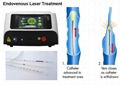 Varicose Veins Endovenous Laser Therapy Treatment Ablation 980nm Wavelength 1