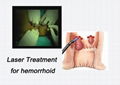 Berylas Laser Treatment For Hemorrhoids