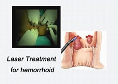 Berylas Laser Treatment For Hemorrhoids Rapid And Unimpaired Healing