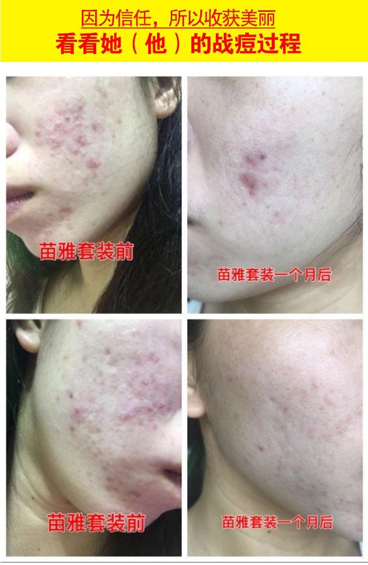 Traditional Chinese medicine acne cream oem 5