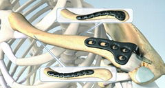 锁骨S型锁定接骨板Ⅱ型(左/右) 创伤 骨科 植入物 纯钛